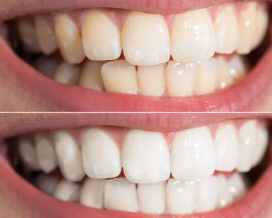 Przebarwienia zębów – jak powstają i jak im zaradzić?