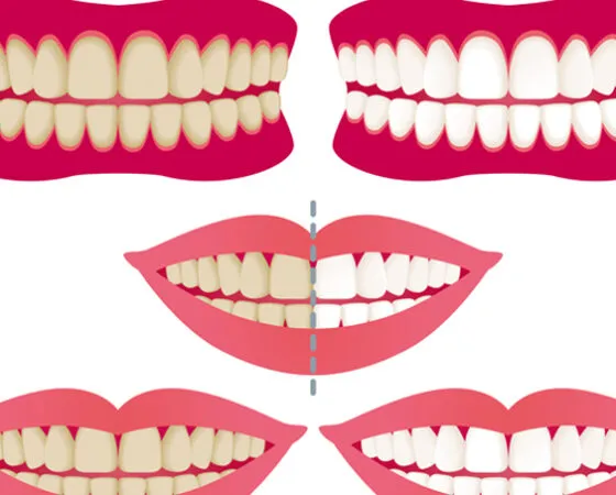 Wybielanie zębów – jak skutecznie i bezpiecznie usunąć przebarwienia zębów i wybielić zęby? Co warto wiedzieć o wybielaniu zębów.