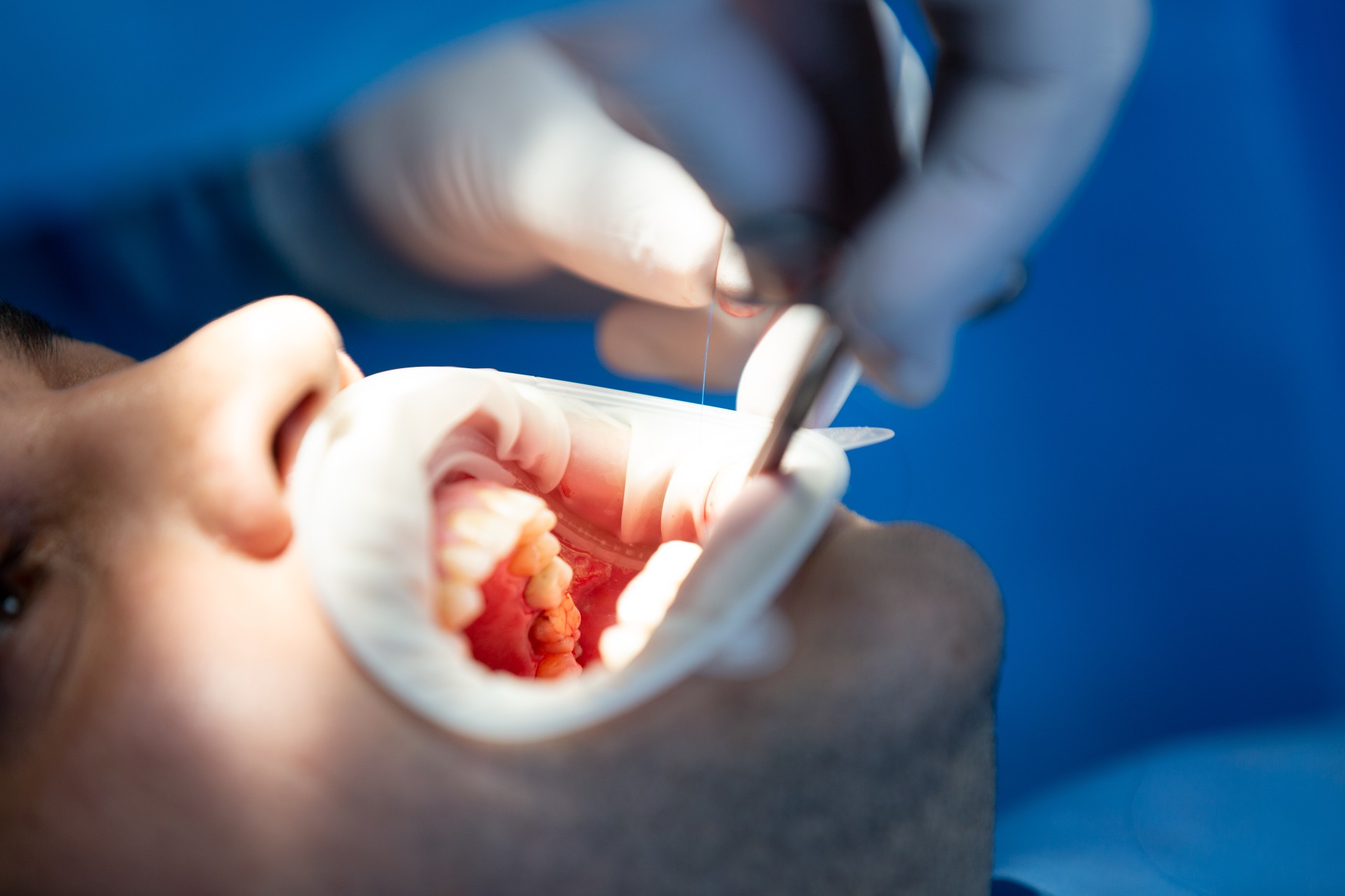 Czy leczenie kanałowe boli? Fakty i mity o endodoncji w znieczuleniu
